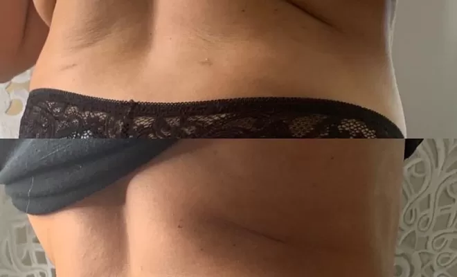 Amincissement, Lormont, Adikt Beauty