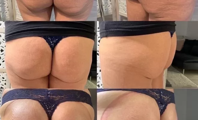 Lifting colombien, Lormont, Adikt Beauty